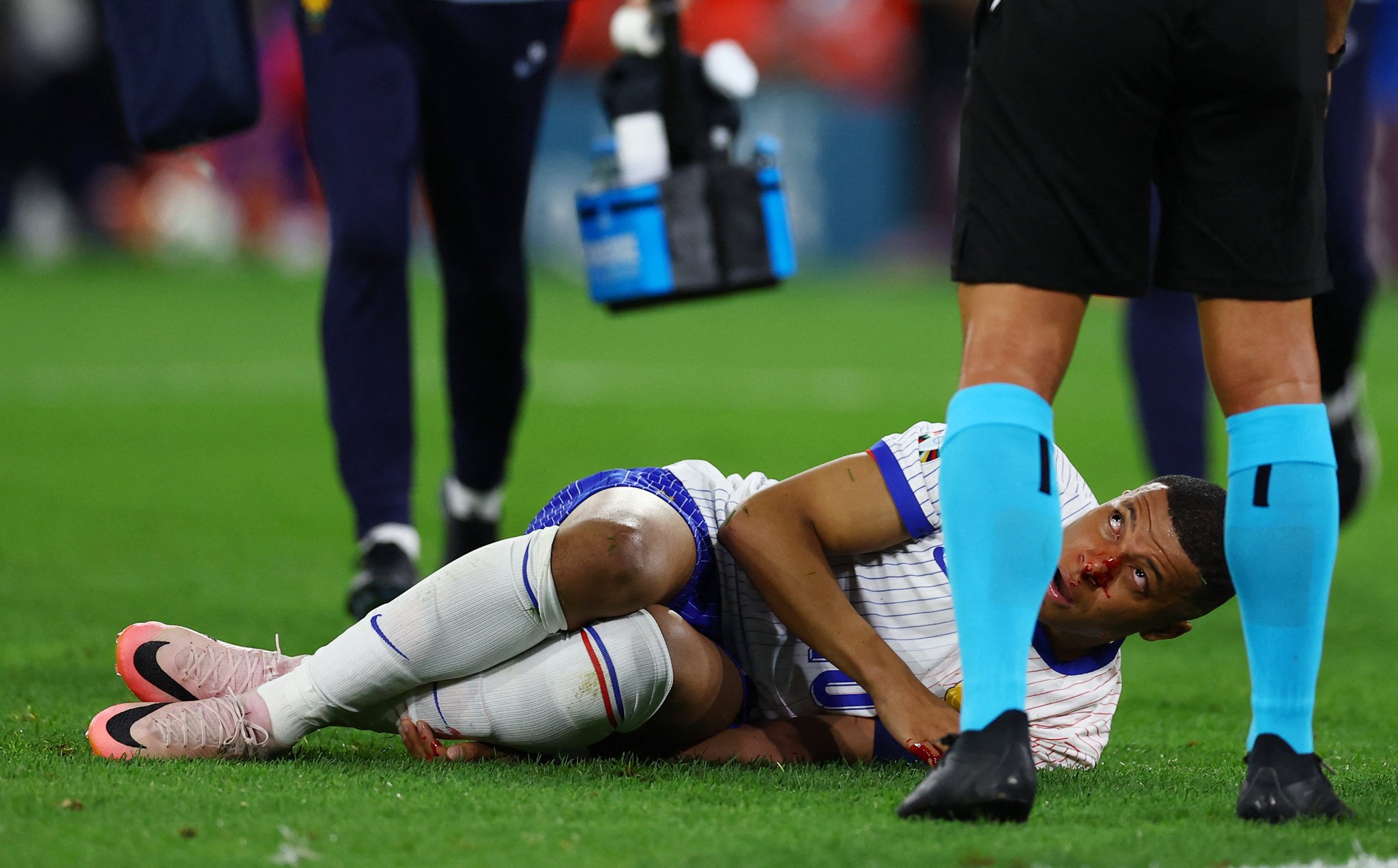 Kylian Mbappe Sustains Broken Nose In France Won Over Austria